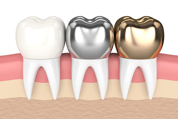 metal-crowns-vs-porcelain-dental-crowns.jpg
